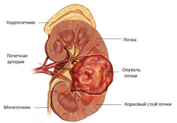 к факторам риска рака почки относится к_факторам_риска_рака_почки_относится_1.png