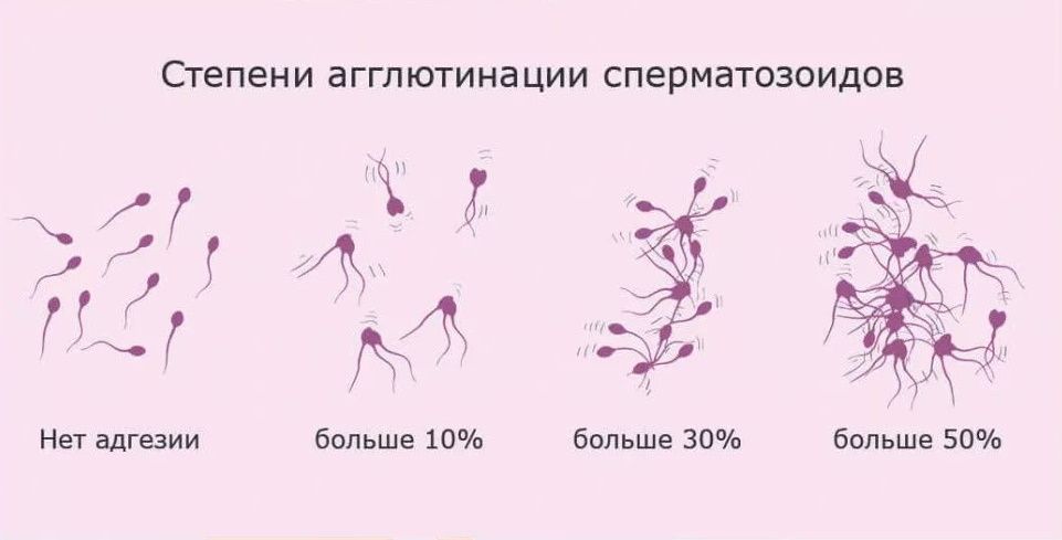 Степени агглютинации сперматозоидов Степени агглютинации сперматозоидов